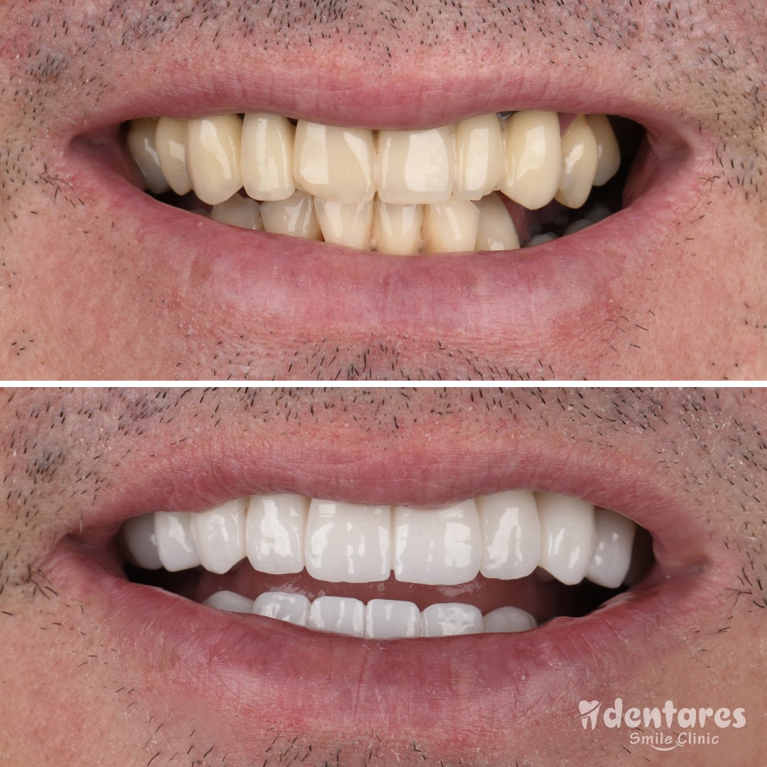 Discover Your Best Smile in Antalya: Before & After Gallery!