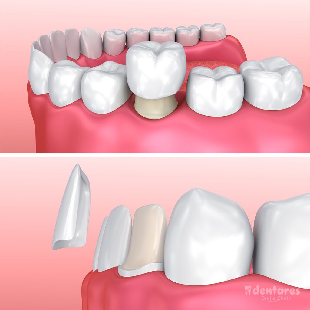 Are Dental Crowns Or Veneers Better?