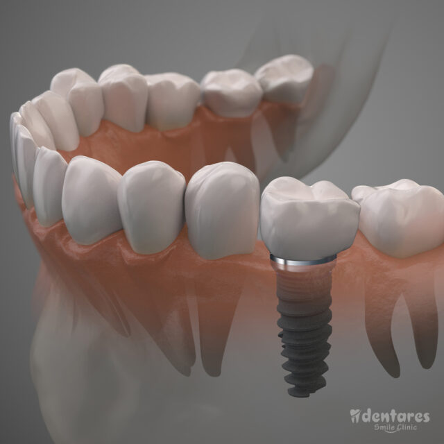 How Much Are Dental Implants In Turkey