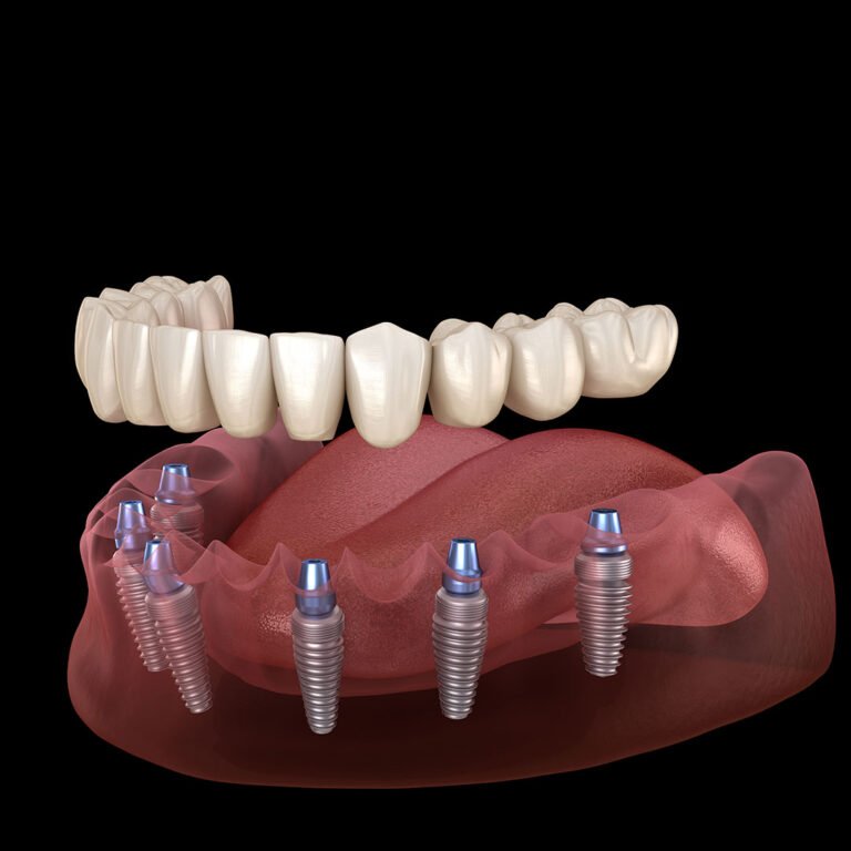 All on 6 Dental Implants