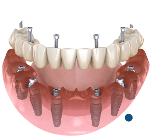 3 on 6 Dental Implants