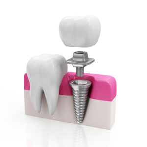 how is work dental implants