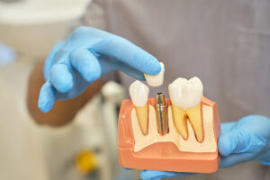 Dental Implants Turkey Antalya