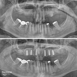 Same-Day-Dental-Implants-1