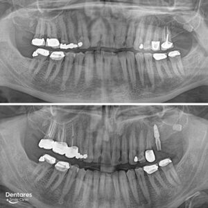 Same-Day-Dental-Implants-2