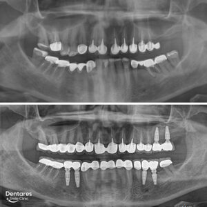 Same-Day-Dental-Implants-4