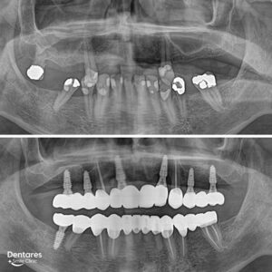 Slide-Dental-Implants