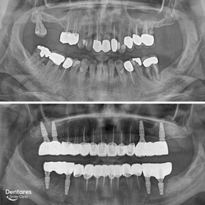 Slide-Dental-Implants