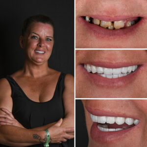 Slide-Full-Mouth-Dental-Implants-1