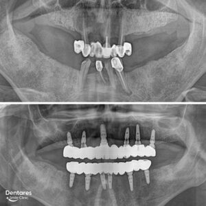 Slide-Full-Mouth-Dental-Implants-4