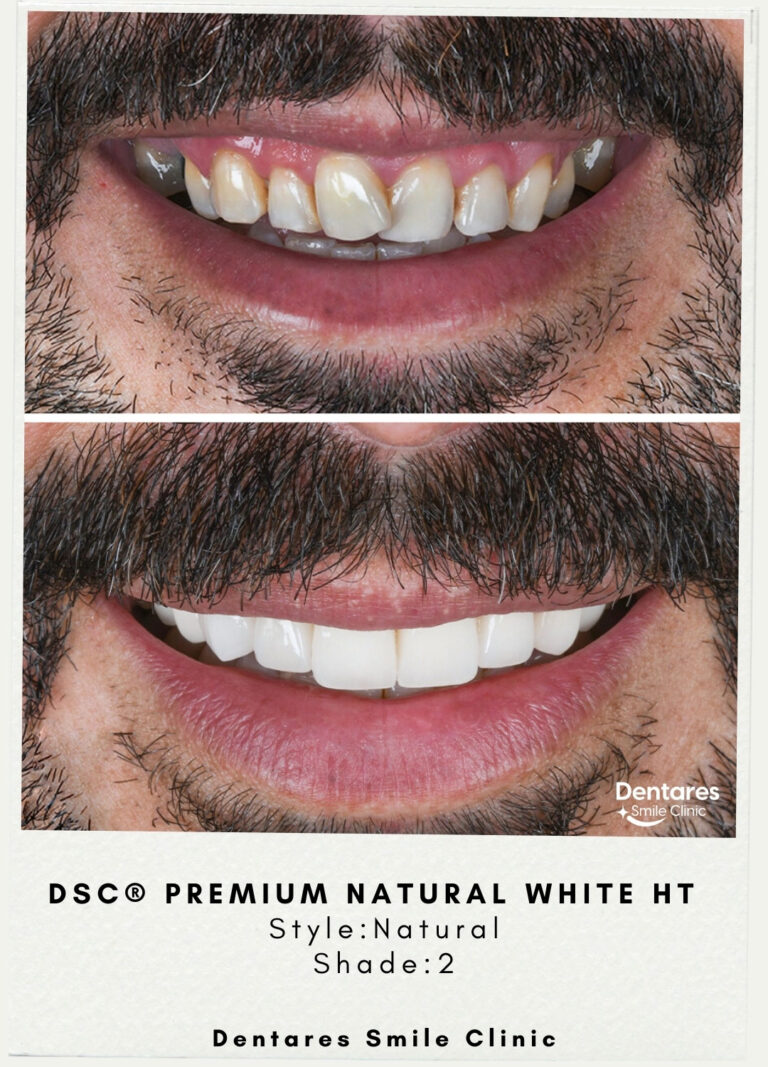 DSC-3-Premium-Natural-White-HT-Style-Dentares-Shade1-2