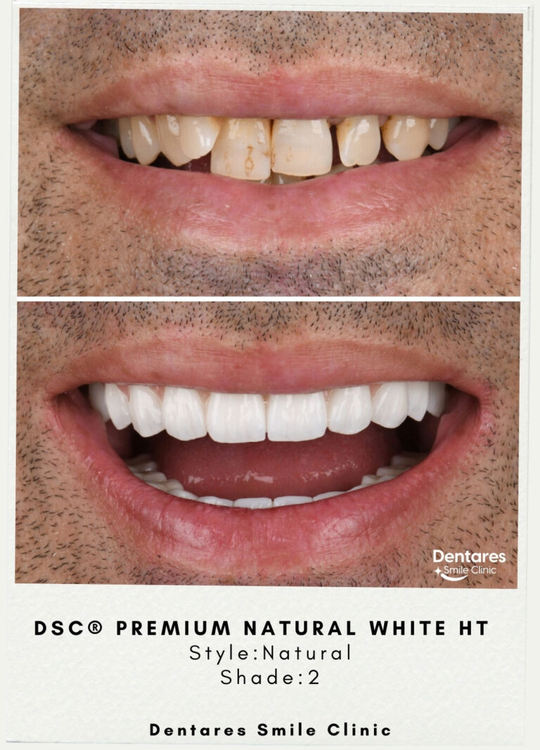 DSC-3-Premium-Natural-White-HT-Style-Dentares-Shade1-3