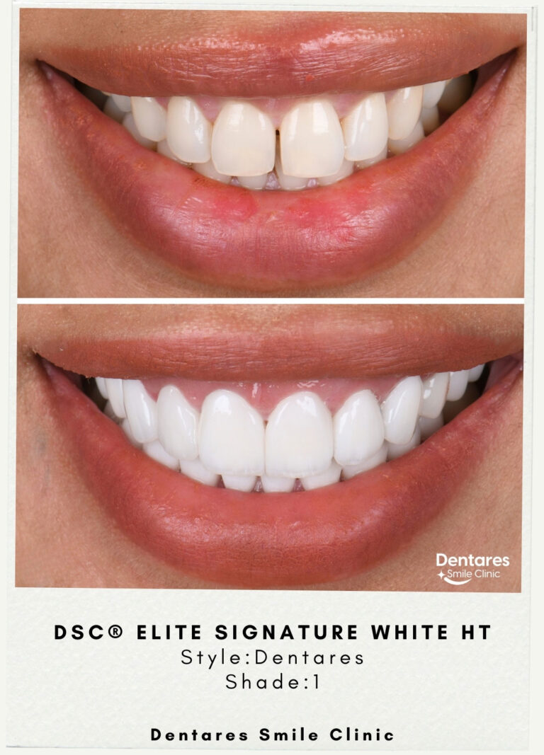 DSC-Elite-Signature-White-HT-Style-Dentares-Shade1-1