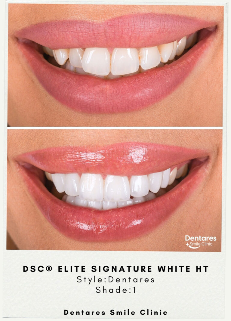 DSC-Elite-Signature-White-HT-Style-Dentares-Shade1-2