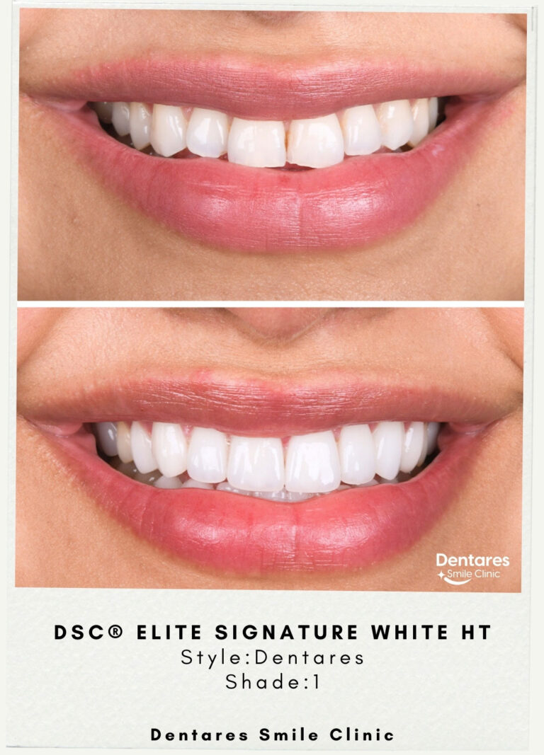 DSC-Elite-Signature-White-HT-Style-Dentares-Shade1-3