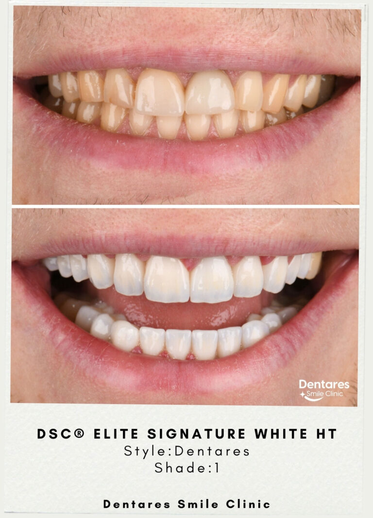 DSC-Elite-Signature-White-HT-Style-Dentares-Shade1-4