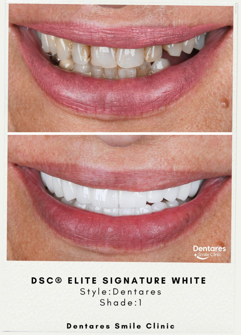 DSC-Elite-Signature-White-Style-Dentares-Shade1-1