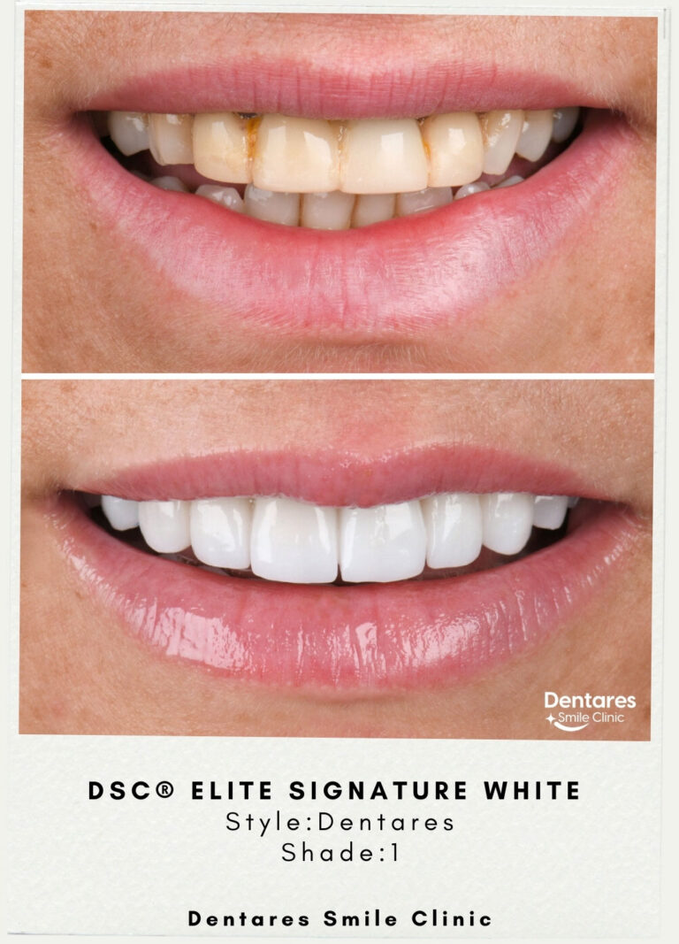 DSC-Elite-Signature-White-Style-Dentares-Shade1-2