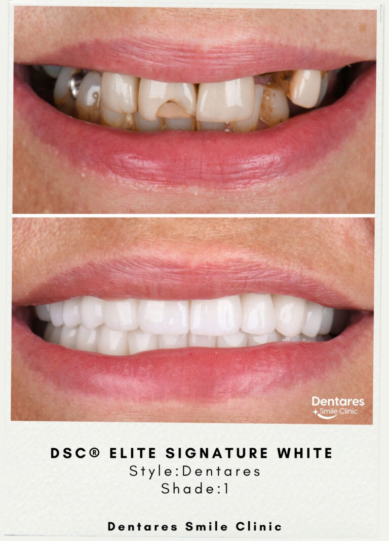 DSC-Elite-Signature-White-Style-Dentares-Shade1-3