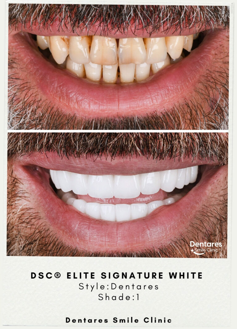 DSC-Elite-Signature-White-Style-Dentares-Shade1-4