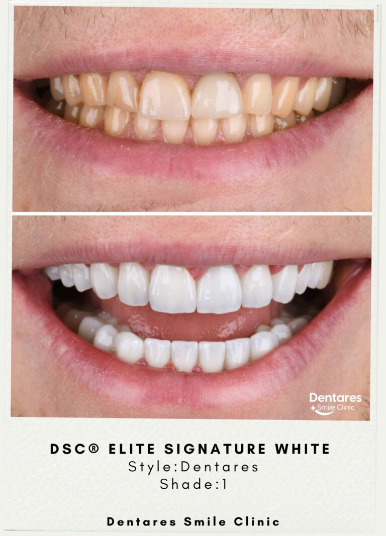 DSC-Elite-Signature-White-Style-Dentares-Shade1-5