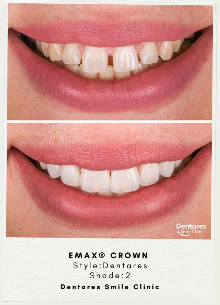 Emax-Crown-Edited-Polaroid-Before-After