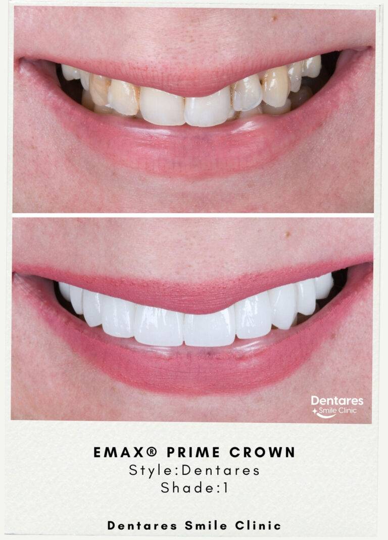 Emax-Prime-Crown-1