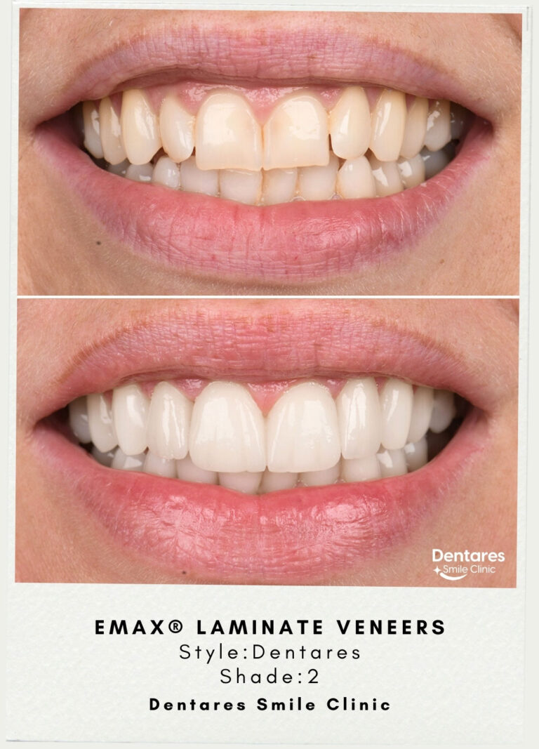 emax-laminate-veneers-1
